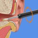 NE3pro Otoscope: High-Resolution 1080P HD Video, Elimination Spoon, and Advanced Load Otoscope