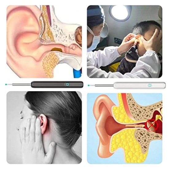 NE3pro Otoscope: High-Resolution 1080P HD Video, Elimination Spoon, and Advanced Load Otoscope
