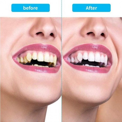 Ultrasonic Tooth Cleaner Tartar Remover 5-Speed Rechargeable Dental Care for a Healthy Smile